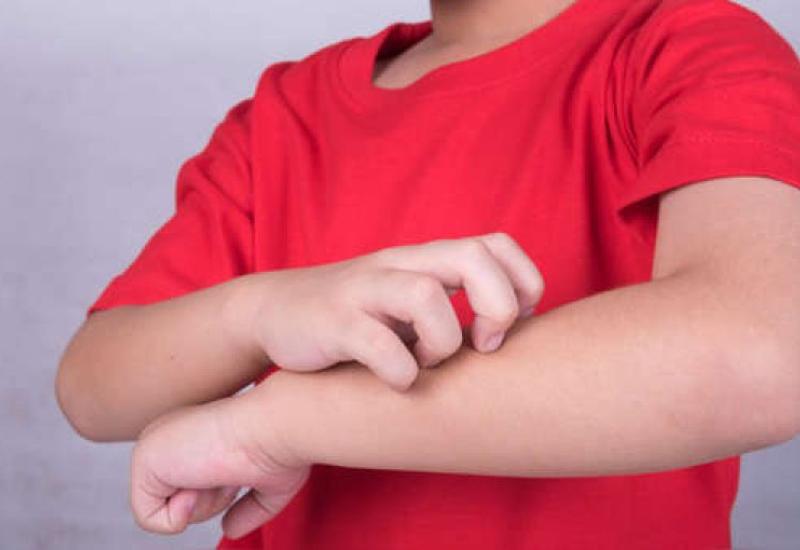 Tratamiento de Dermatitis Atópica, Municipio de San ISidro