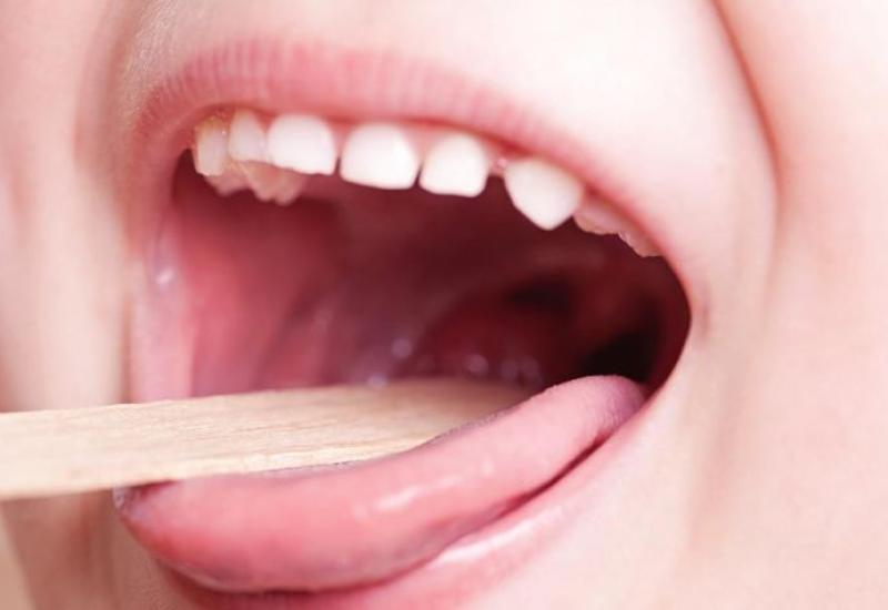 Infección bacteriana, Streptococcus pyogenes