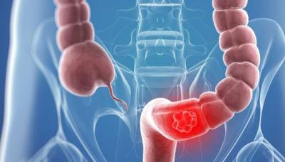 DETECCIÓN TEMPRANA DEL CÁNCER DE COLON